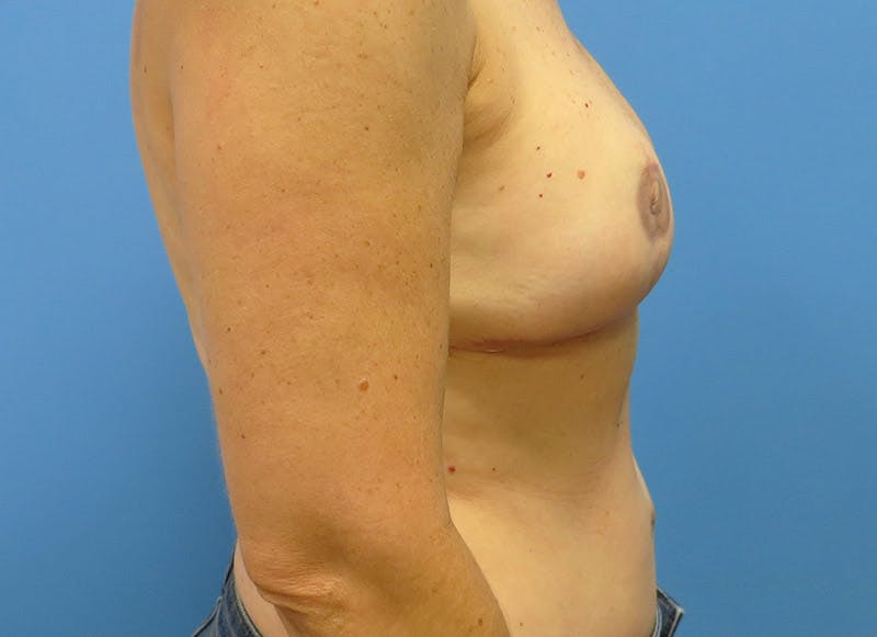 Flap Reconstruction Gallery Before & After Gallery - Patient 112337952 - Image 10