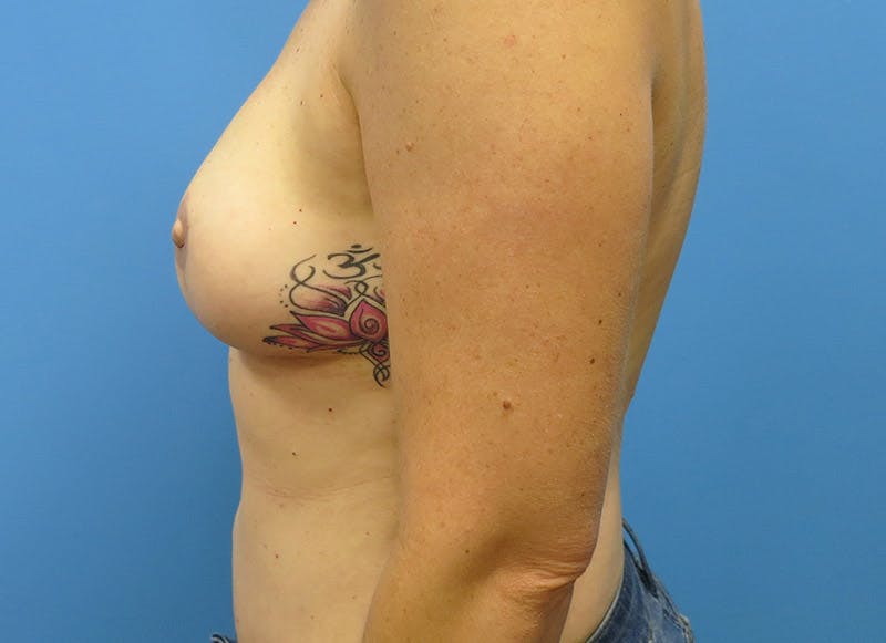 Flap Reconstruction Gallery Before & After Gallery - Patient 112337952 - Image 2