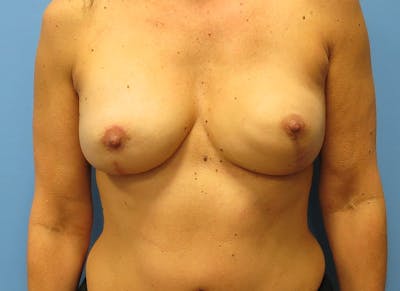 Flap Reconstruction Gallery Before & After Gallery - Patient 112337957 - Image 6