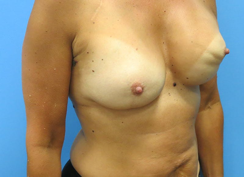 Flap Reconstruction Gallery Before & After Gallery - Patient 112337957 - Image 7