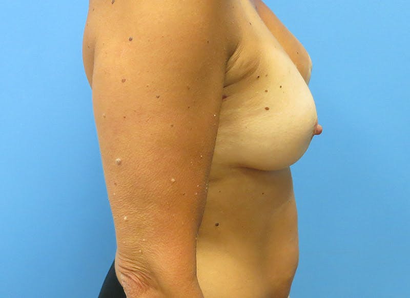 Flap Reconstruction Gallery Before & After Gallery - Patient 112337957 - Image 9