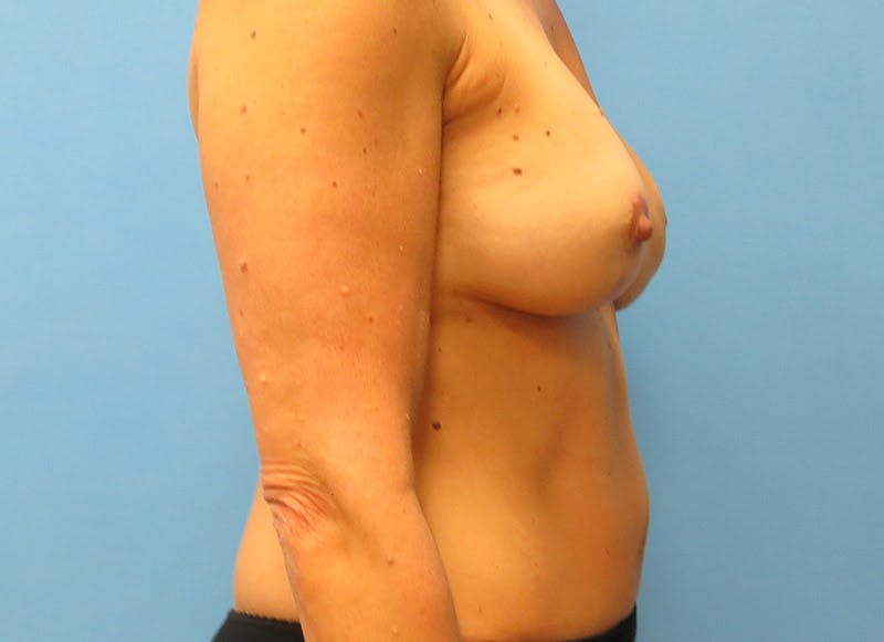 Flap Reconstruction Gallery Before & After Gallery - Patient 112337957 - Image 10