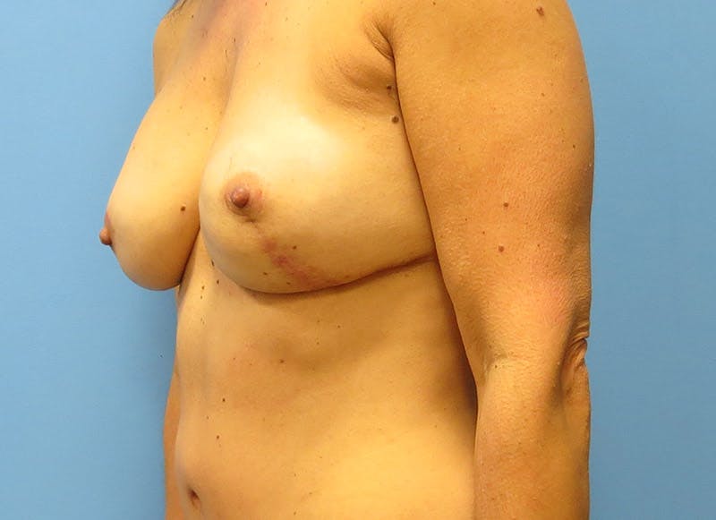 Flap Reconstruction Gallery Before & After Gallery - Patient 112337957 - Image 4
