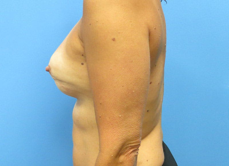 Flap Reconstruction Gallery Before & After Gallery - Patient 112337957 - Image 1