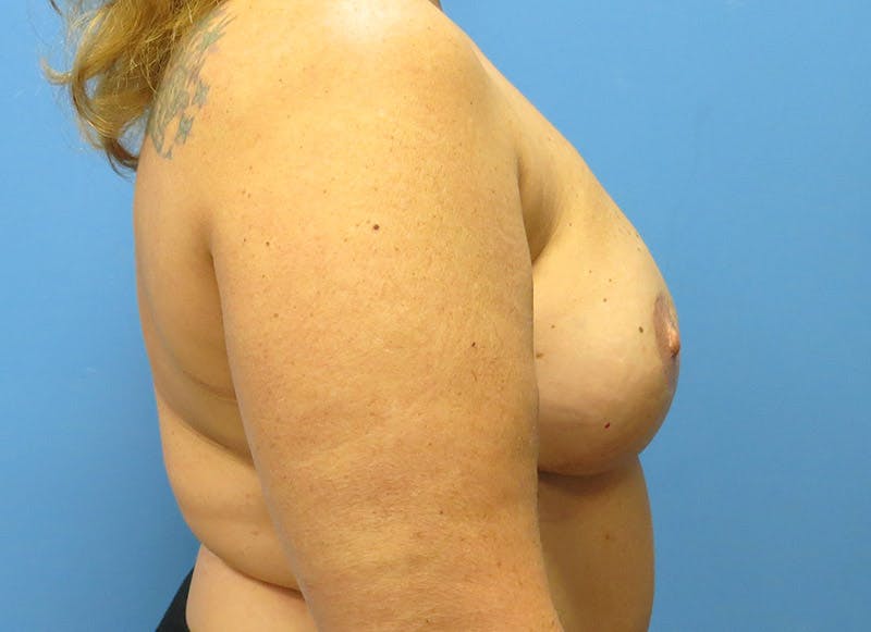 Flap Reconstruction Gallery Before & After Gallery - Patient 112337963 - Image 10