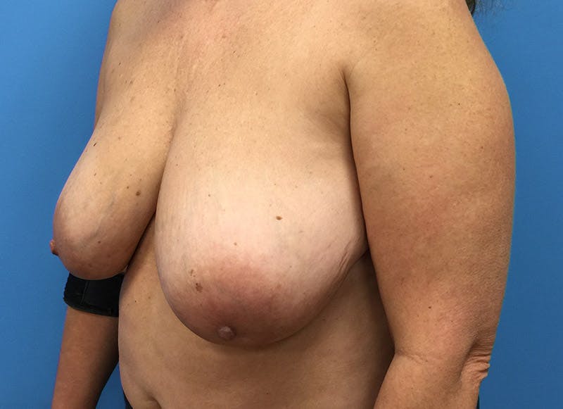 Flap Reconstruction Gallery Before & After Gallery - Patient 112337963 - Image 3