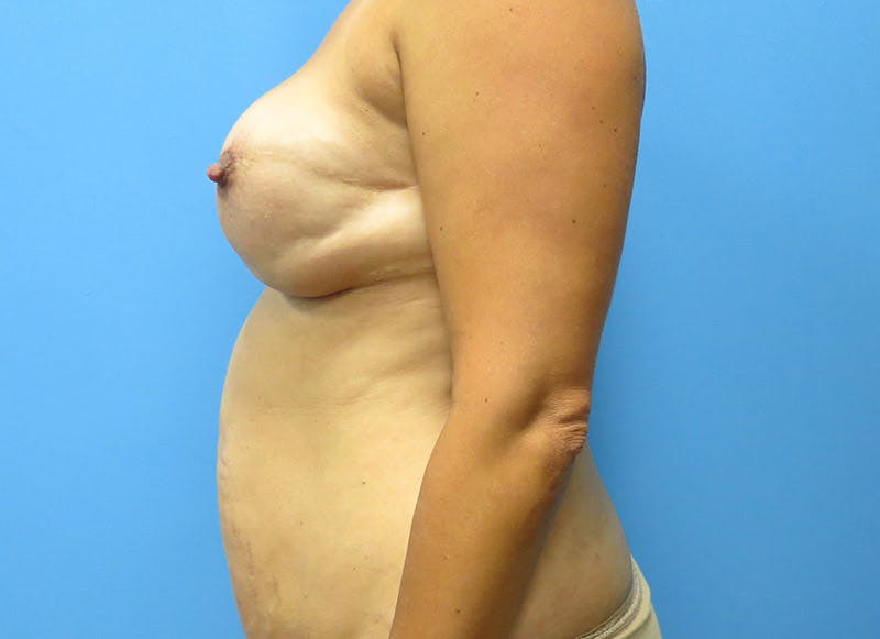 Flap Reconstruction Gallery Before & After Gallery - Patient 112337965 - Image 1