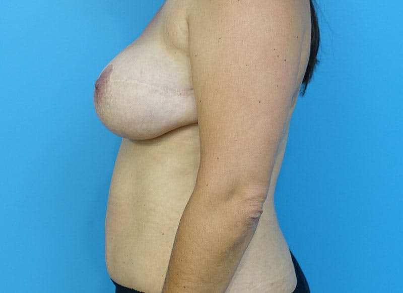 Flap Reconstruction Gallery Before & After Gallery - Patient 112337965 - Image 2