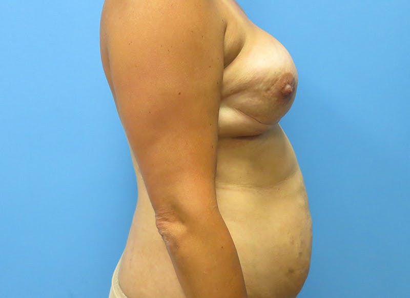 Flap Reconstruction Before & After Gallery - Patient 112337965 - Image 9