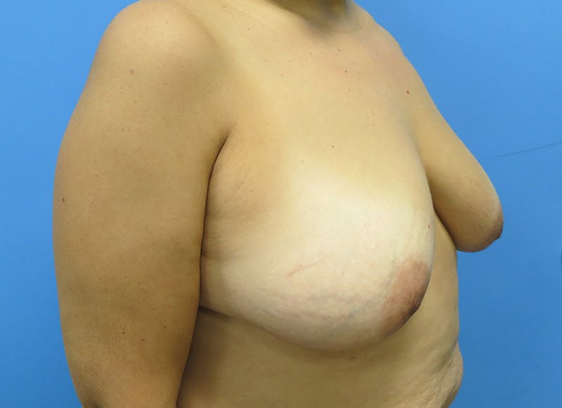 Flap Reconstruction Gallery Before & After Gallery - Patient 112337969 - Image 7