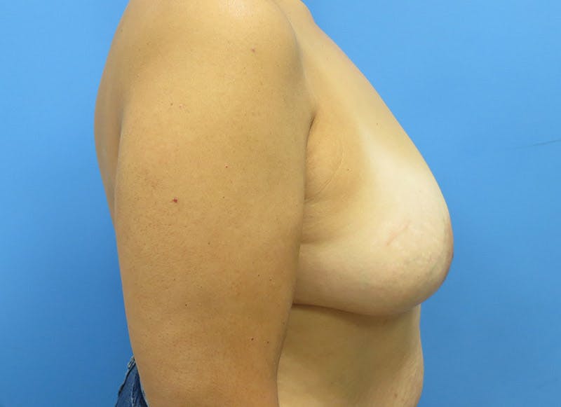 Flap Reconstruction Gallery Before & After Gallery - Patient 112337969 - Image 9