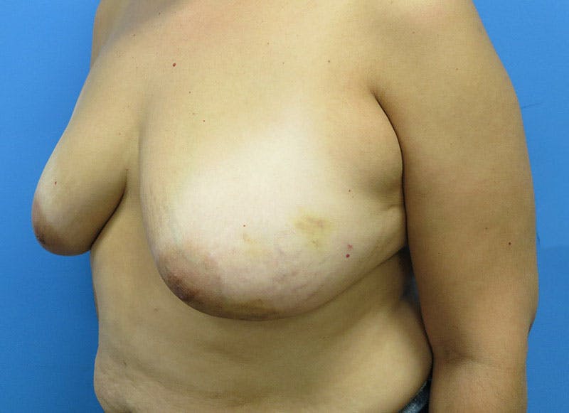 Flap Reconstruction Gallery Before & After Gallery - Patient 112337969 - Image 3