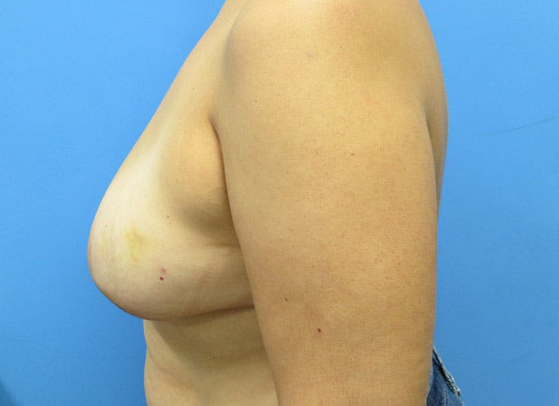 Flap Reconstruction Gallery Before & After Gallery - Patient 112337969 - Image 1