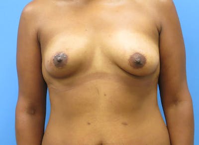 Flap Reconstruction Gallery Before & After Gallery - Patient 112337971 - Image 5