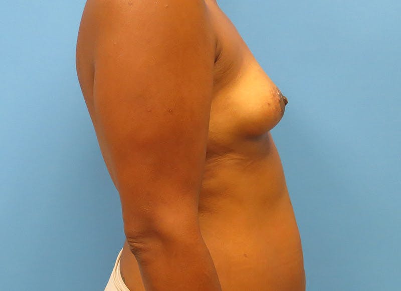 Flap Reconstruction Gallery Before & After Gallery - Patient 112337971 - Image 9