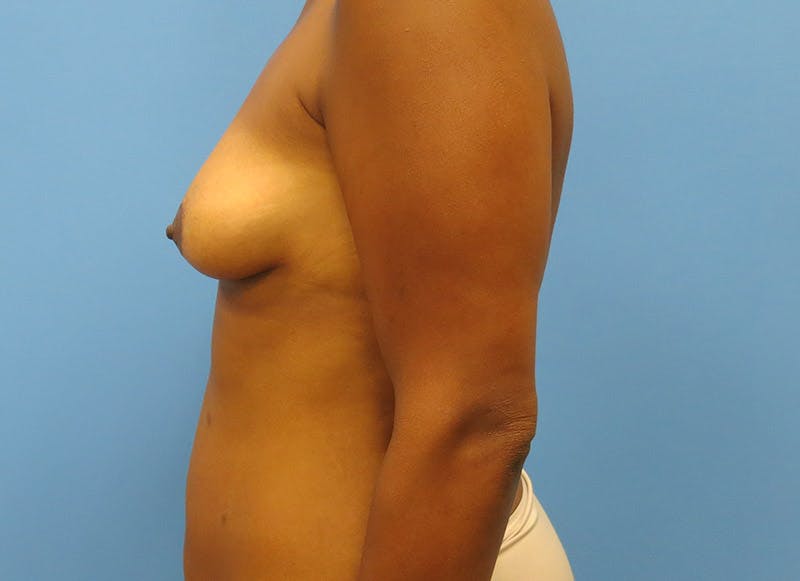 Flap Reconstruction Gallery Before & After Gallery - Patient 112337971 - Image 1