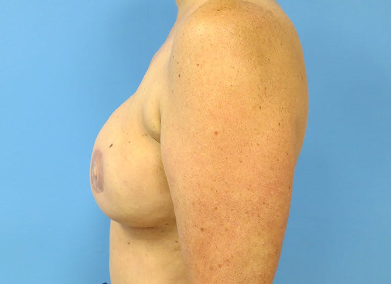 Flap Reconstruction Gallery Before & After Gallery - Patient 112338006 - Image 2