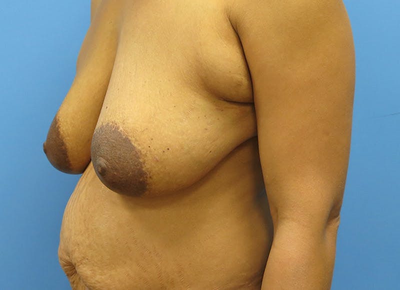 Flap Reconstruction Gallery Before & After Gallery - Patient 112338010 - Image 3