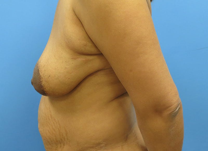 Flap Reconstruction Gallery Before & After Gallery - Patient 112338010 - Image 1