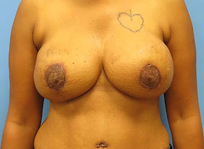 Flap Reconstruction Gallery Before & After Gallery - Patient 112338011 - Image 6