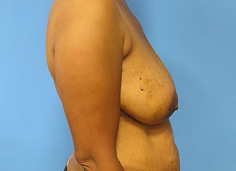 Flap Reconstruction Gallery Before & After Gallery - Patient 112338011 - Image 9