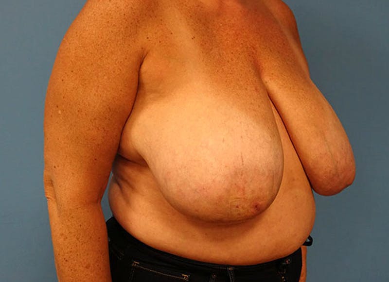 Flap Reconstruction Before & After Gallery - Patient 112338015 - Image 7