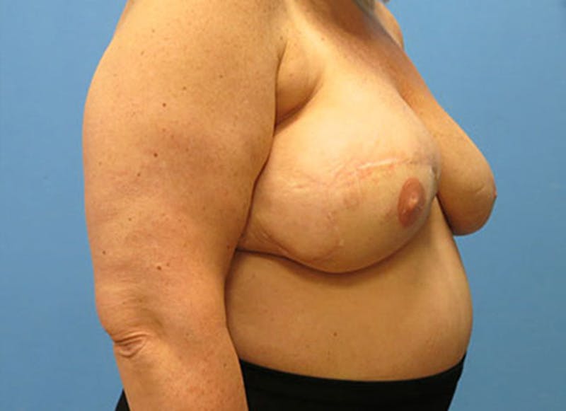 Flap Reconstruction Gallery Before & After Gallery - Patient 112338015 - Image 8