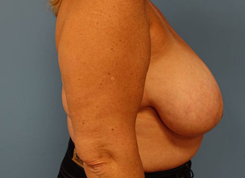 Flap Reconstruction Gallery Before & After Gallery - Patient 112338015 - Image 9