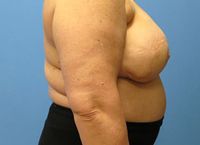 Flap Reconstruction Gallery Before & After Gallery - Patient 112338015 - Image 10