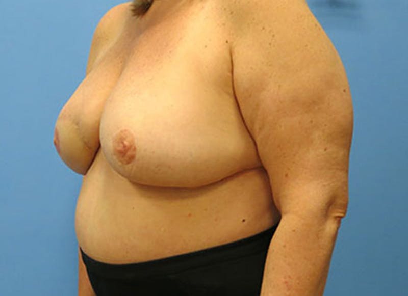 Flap Reconstruction Before & After Gallery - Patient 112338015 - Image 4
