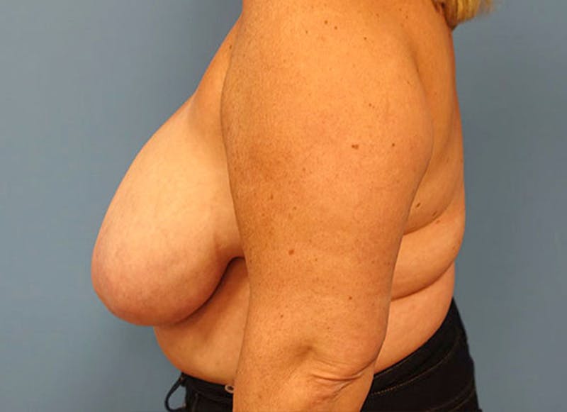 Flap Reconstruction Gallery Before & After Gallery - Patient 112338015 - Image 1
