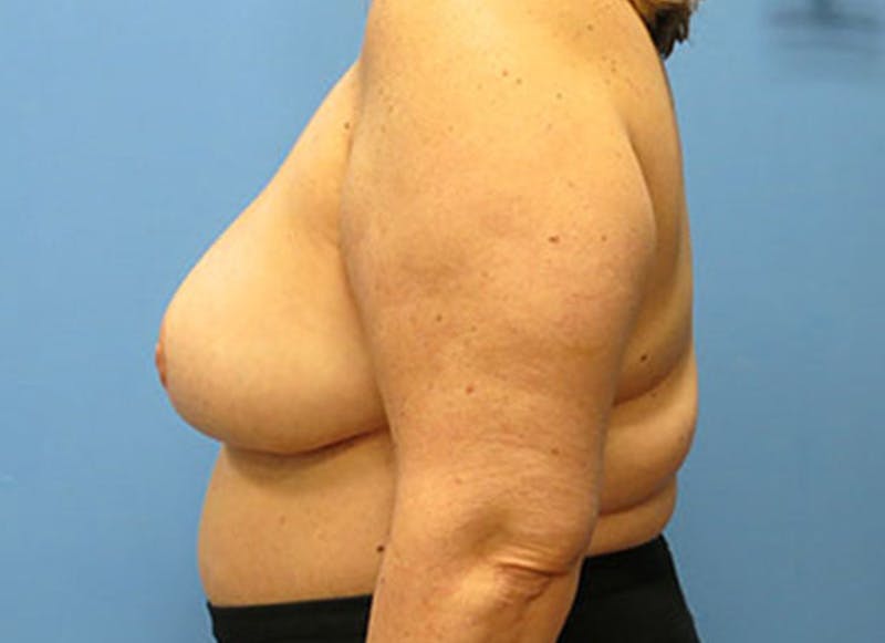 Flap Reconstruction Before & After Gallery - Patient 112338015 - Image 2