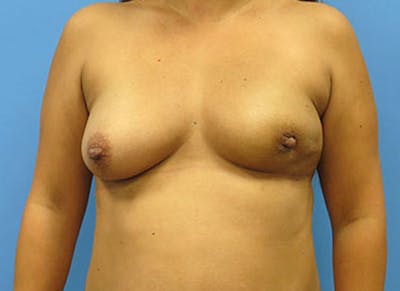 Flap Reconstruction Gallery Before & After Gallery - Patient 112338017 - Image 5