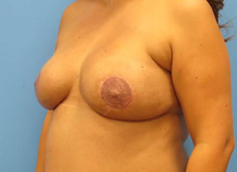 Flap Reconstruction Gallery Before & After Gallery - Patient 112338017 - Image 4