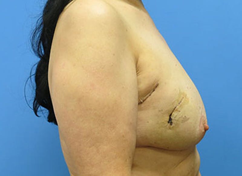 Flap Reconstruction Gallery Before & After Gallery - Patient 112338018 - Image 9