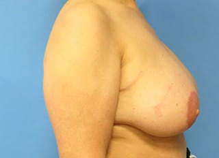 Flap Reconstruction Gallery Before & After Gallery - Patient 112338018 - Image 10