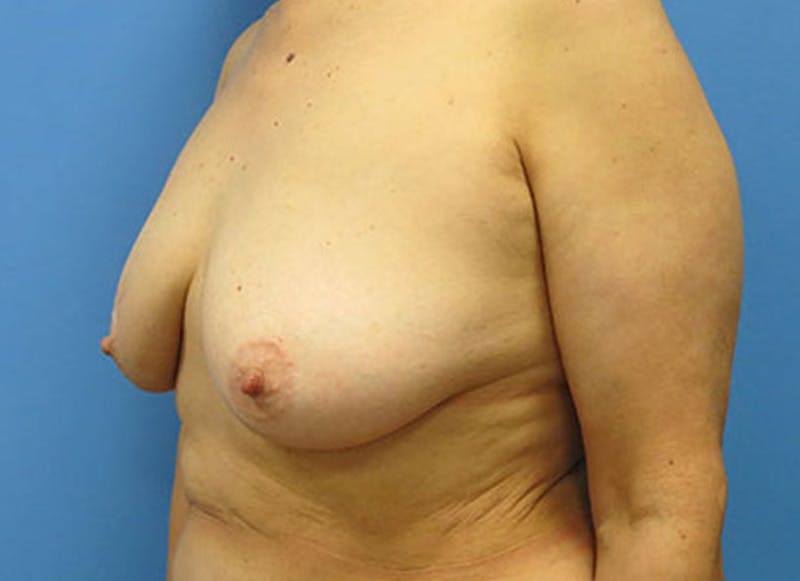Flap Reconstruction Gallery Before & After Gallery - Patient 112338018 - Image 3