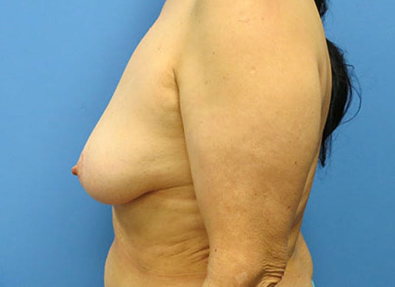 Flap Reconstruction Gallery Before & After Gallery - Patient 112338018 - Image 1