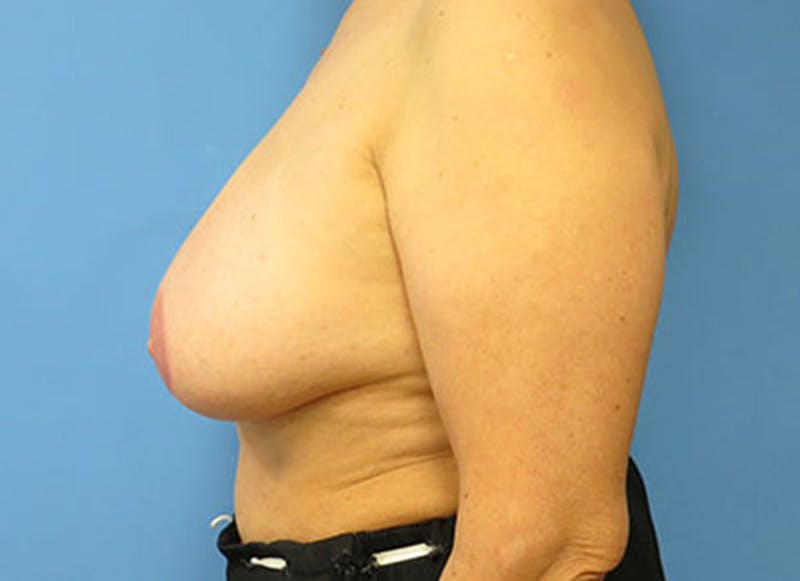 Flap Reconstruction Gallery Before & After Gallery - Patient 112338018 - Image 2