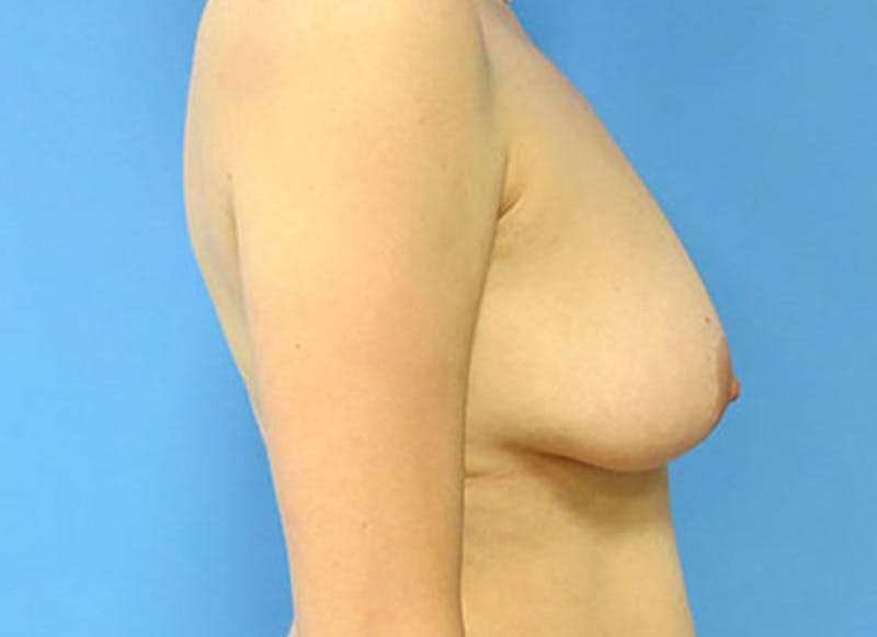 Flap Reconstruction Gallery Before & After Gallery - Patient 112338020 - Image 9