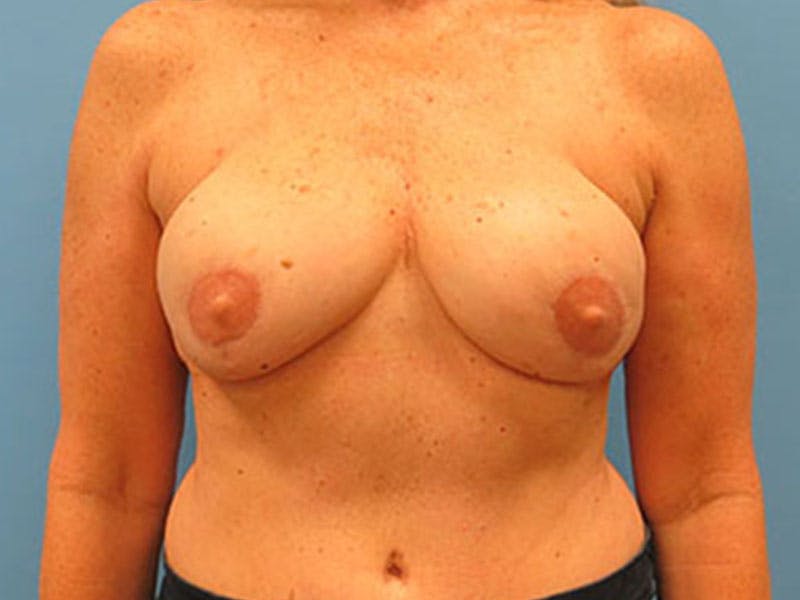Flap Reconstruction Gallery Before & After Gallery - Patient 112338021 - Image 6