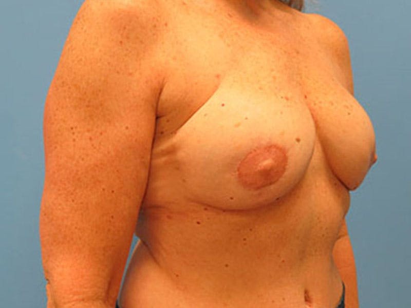 Flap Reconstruction Before & After Gallery - Patient 112338021 - Image 8