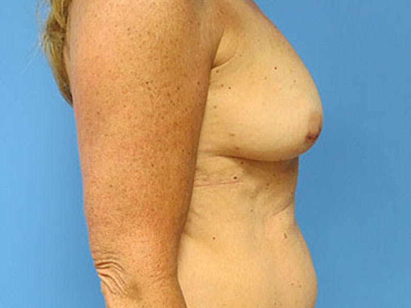 Flap Reconstruction Gallery Before & After Gallery - Patient 112338021 - Image 9