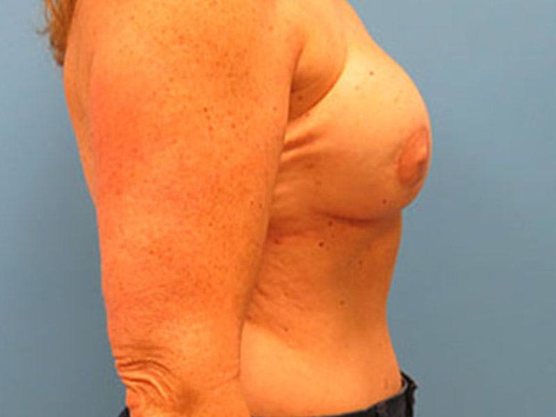 Flap Reconstruction Before & After Gallery - Patient 112338021 - Image 10