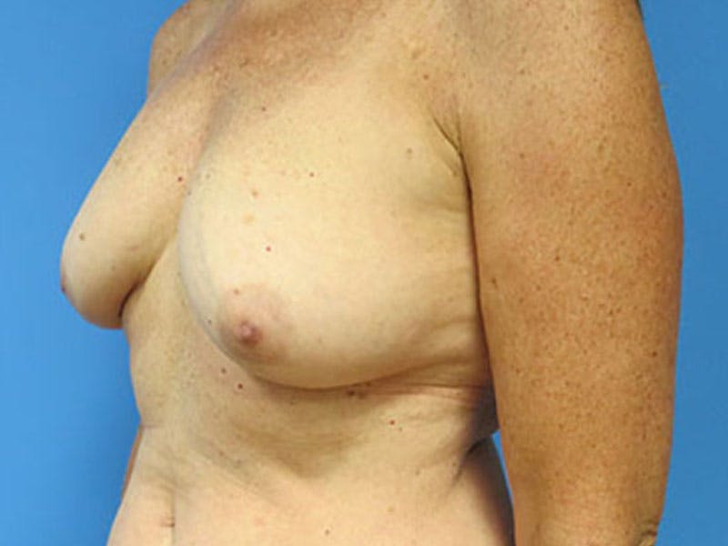 Flap Reconstruction Gallery Before & After Gallery - Patient 112338021 - Image 3