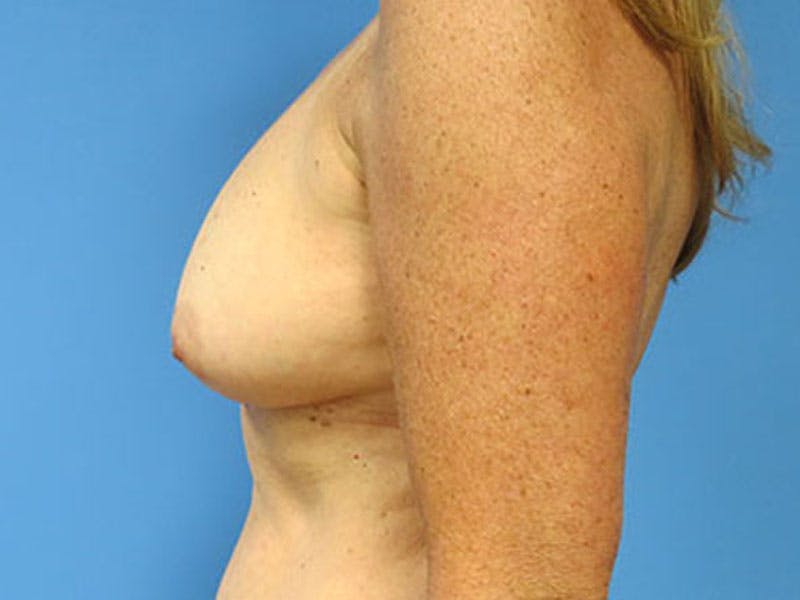 Flap Reconstruction Gallery Before & After Gallery - Patient 112338021 - Image 1