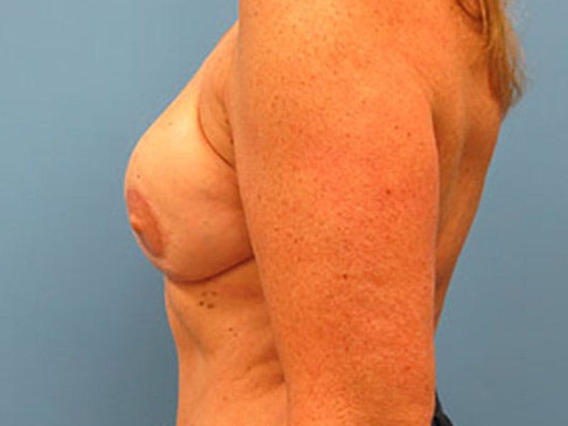 Flap Reconstruction Gallery Before & After Gallery - Patient 112338021 - Image 2