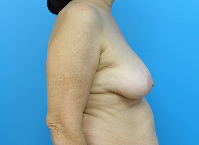 Flap Reconstruction Gallery Before & After Gallery - Patient 112338029 - Image 9