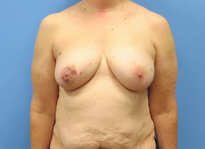 Flap Reconstruction Gallery Before & After Gallery - Patient 112338030 - Image 5