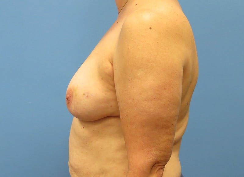 Flap Reconstruction Gallery Before & After Gallery - Patient 112338030 - Image 1